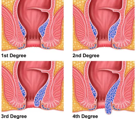 How To Get Rid Of Piles Without Surgery